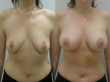 Увеличение птозированной груди